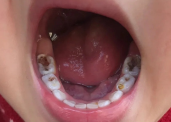 ThS. BS. Nguyễn Quang Tiến – GĐ Trung tâm CĐS Y tế Viện IMRIC; CEO BV RHM SG chia sẻ cách nhận biết sâu răng giai đoạn sớm