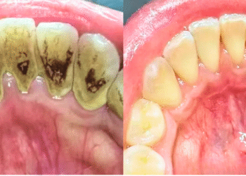 ThS.BS. Nguyễn Quang Tiến – CEO Bệnh viện Răng Hàm Mặt Sài Gòn: ‘kẻ thù thầm lặng’ đang phá hủy răng và năm thói quen gây cao răng của nhiều người