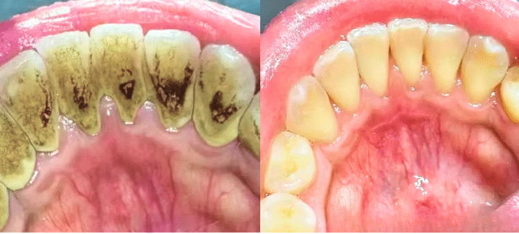 ThS.BS. Nguyễn Quang Tiến – CEO Bệnh viện Răng Hàm Mặt Sài Gòn: ‘kẻ thù thầm lặng’ đang phá hủy răng và năm thói quen gây cao răng của nhiều người